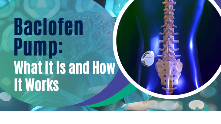 Baclofen Pump What It Is and How It Works