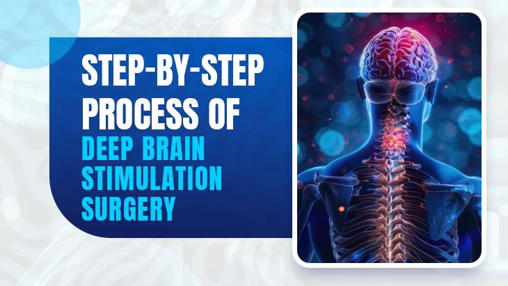 Step-By-Step Process Of Deep Brain Stimulation Surgery