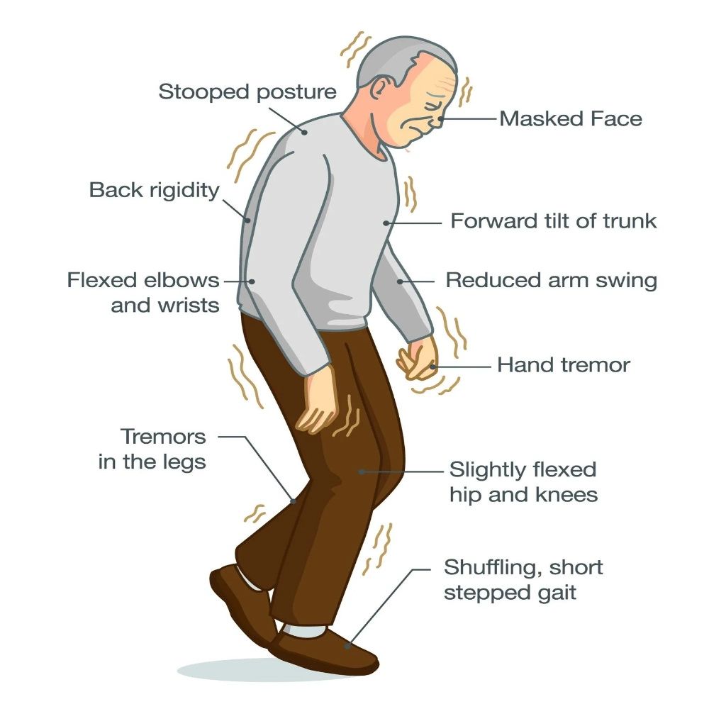 Parkinson’s Disease Surgery
