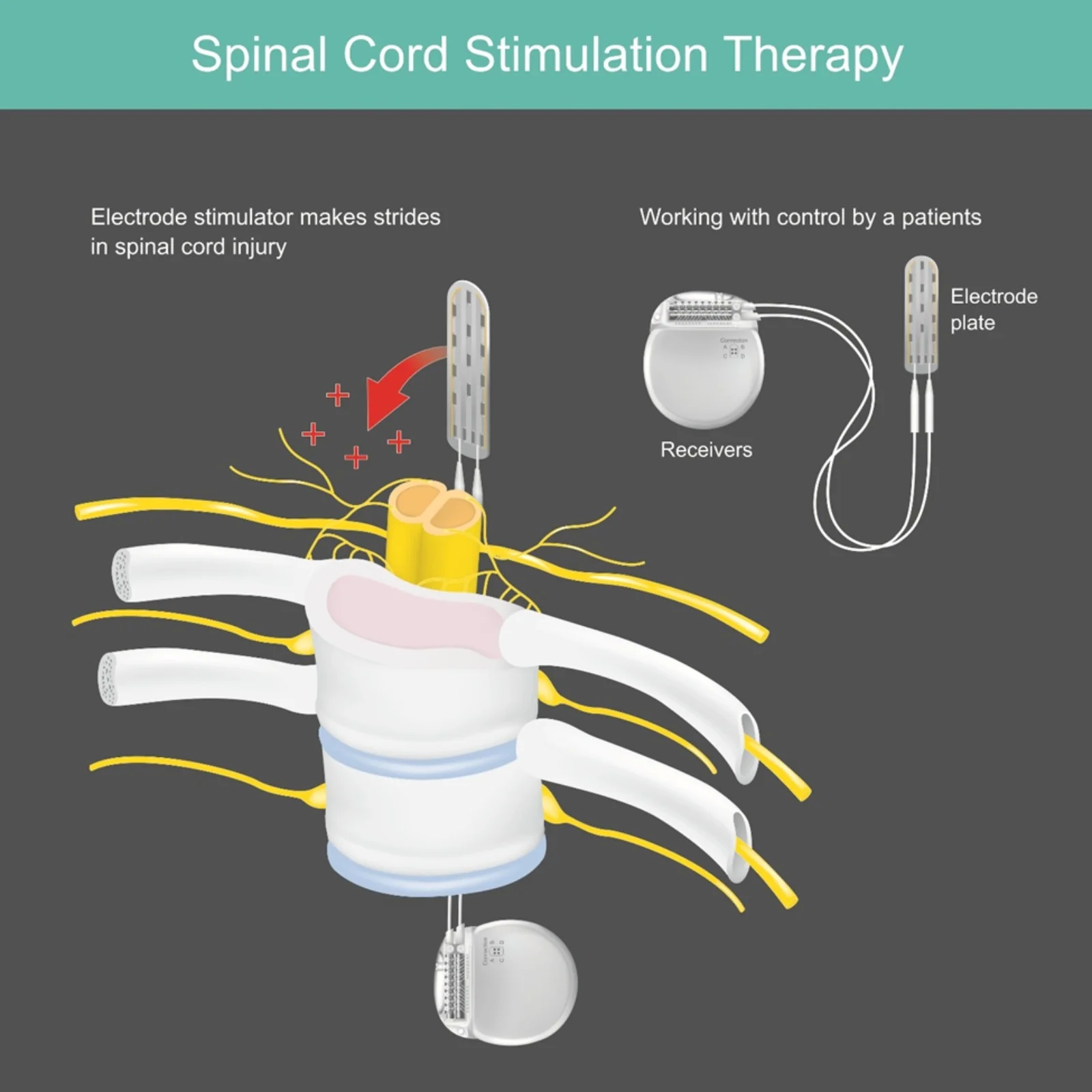 Spinal Cord Stimulation